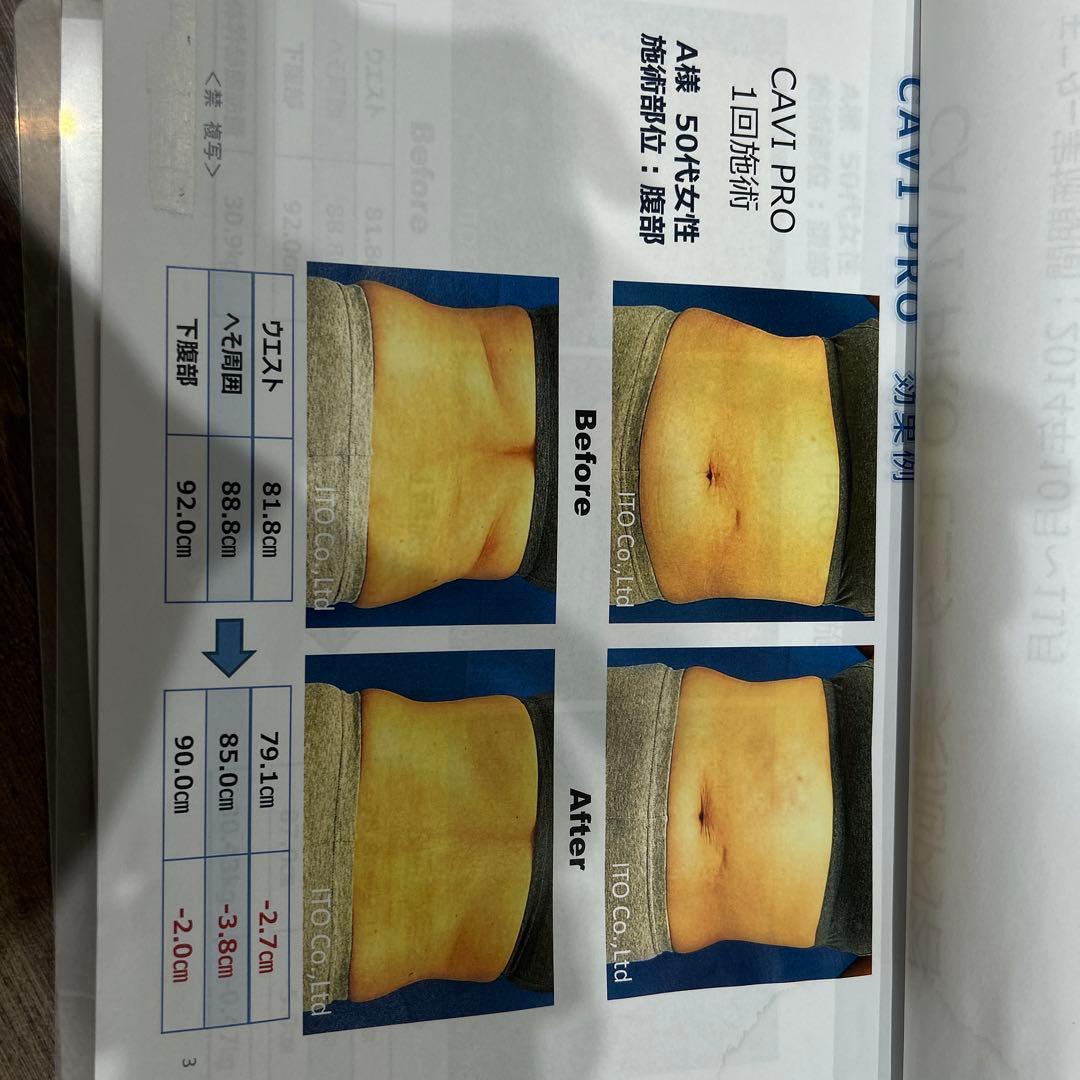 【美品】定価748000円　3分で結果キャビテーション伊藤超短波CAVI PRO