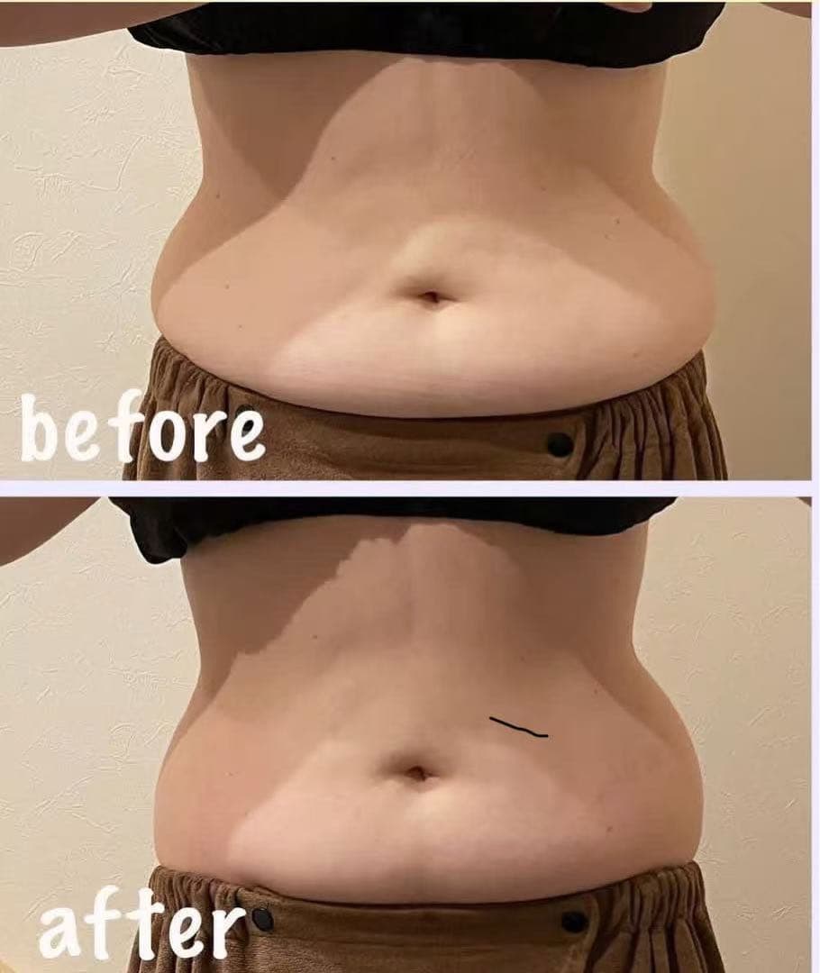 脂肪冷却と電磁パルス４本ハンドル痩身機器