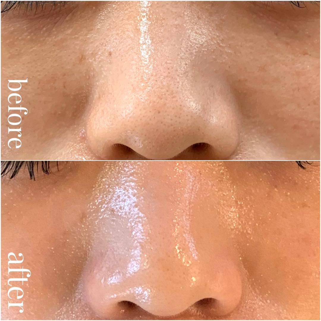 フェイシャル業務用　毛穴洗浄ハイドロマシン　専用美容マスク20枚入りプレゼント！