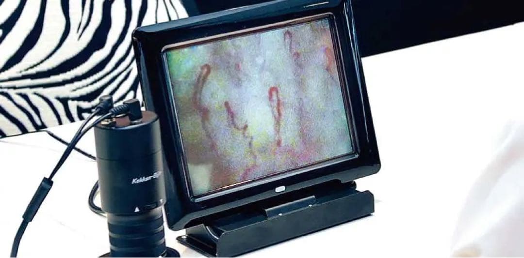 毛細血管スコープ　血管美人　SC-10