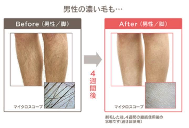 ★ムダ毛ケア フラッシュ式【MEスマートエピレーションプレミアム】光美容器未使用