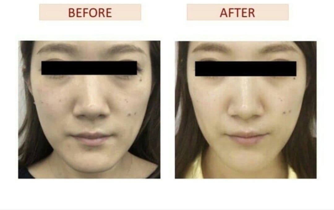 【本物】アクシージア☆GFチャージアドバンス☆美容液導入美肌艶肌水光注射エステ