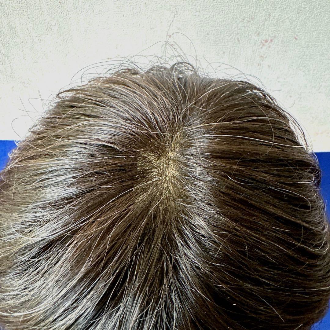 ☆アデランス☆オーダーメイドウィッグ トップピース レディース 白髪混